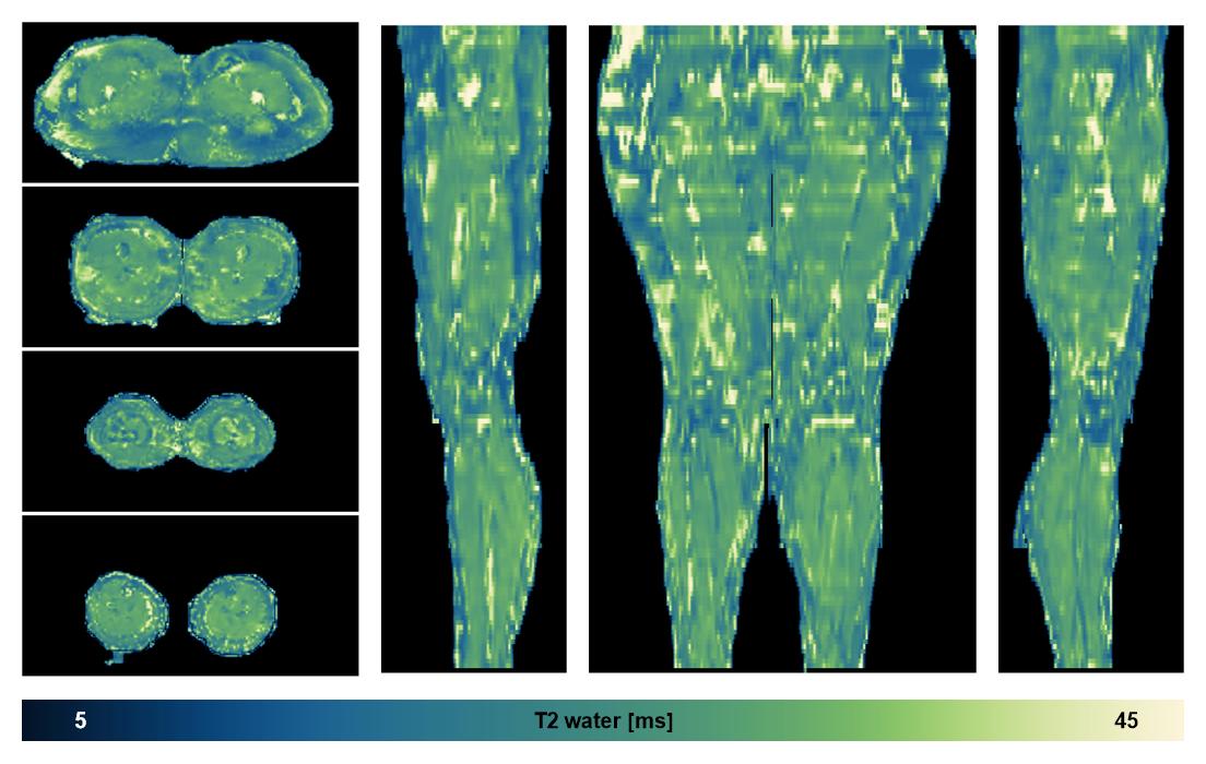 The water only T2 relaxation time of the lower extremity obtained from multi echo spin echo t2 mapping with EPG based reconstruction.